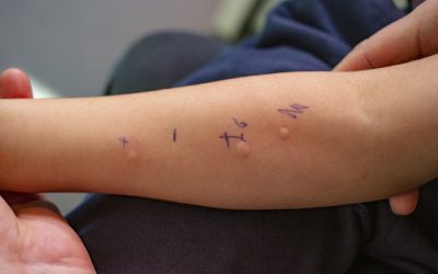 Why Allergy Testing in Primary Care Is Better Than Waiting for a Specialist